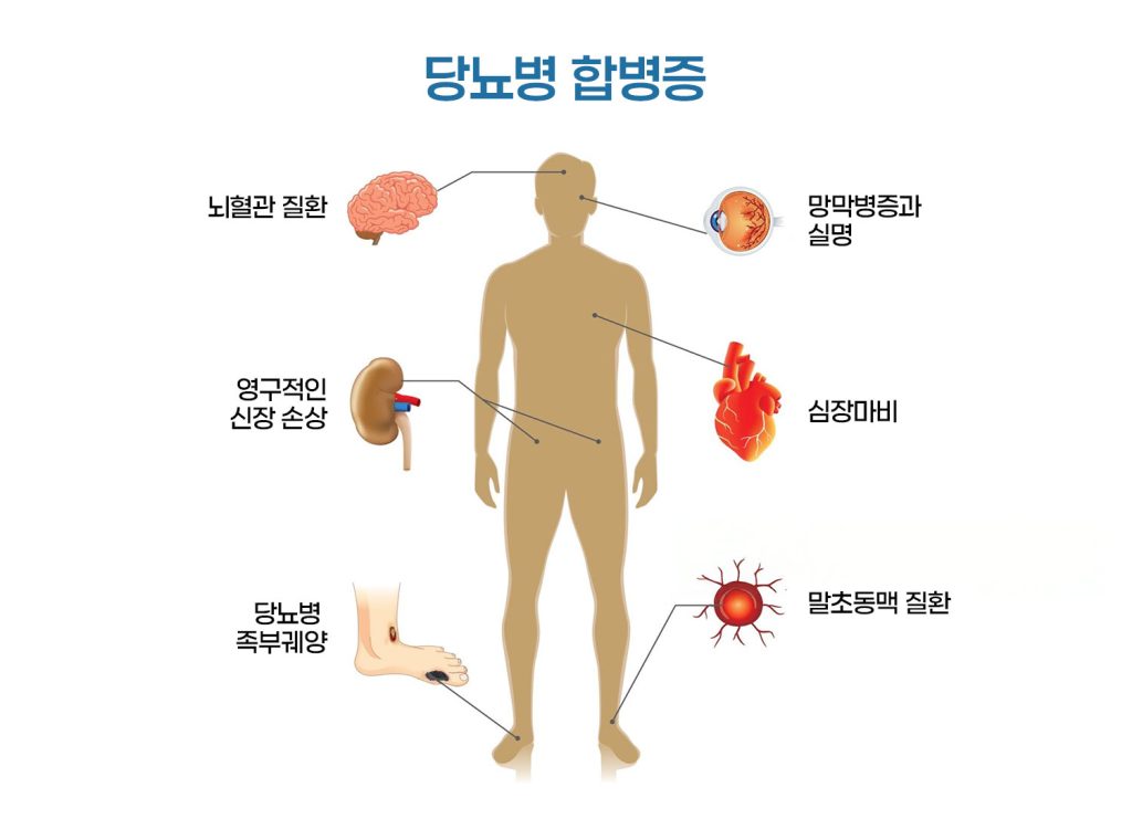 딩뇨합병증