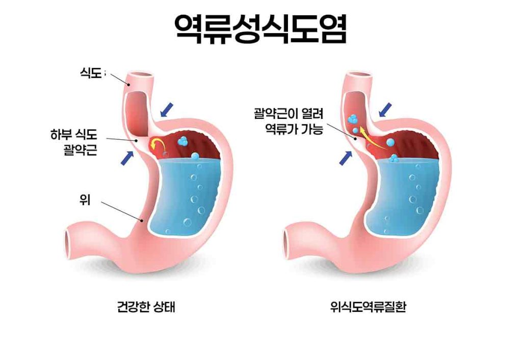 가슴통증과 역류성 식도염